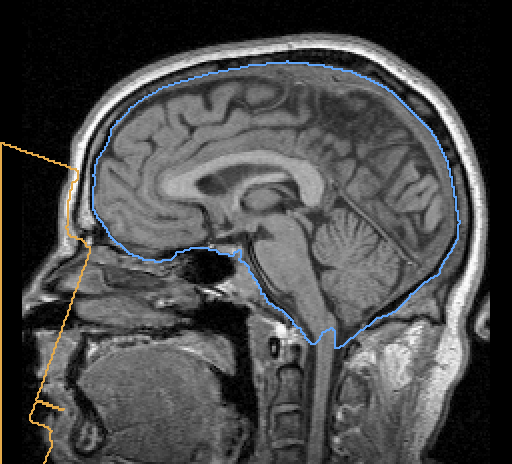 mid-sagittal slice: extracted brain outlined in blue, anonymization region in amber