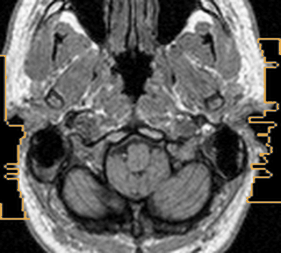 the same slice after the ear cut, region outlined
