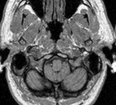 axial slice through both pinnae